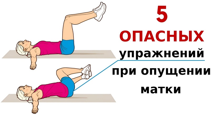 Как НЕЛЬЗЯ делать упражнения при опущении матки, влагалища,