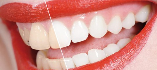 Можно отбелить зубы с пломбами. Можно отбелить зубы с пломбами. Отбел с пломбами на передних зубах. Эндоотбеливание зубов. Отбеливание и наращивание зубов.